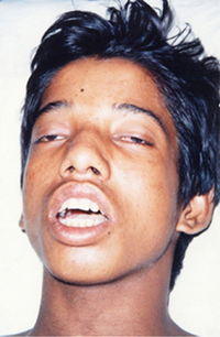 চিত্র:SnakeBite.jpg