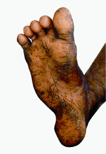 চিত্র:Arsenicosis2.jpg