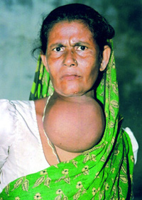 চিত্র:Goiter.jpg