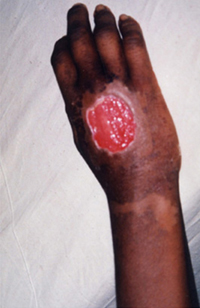 চিত্র:SnakeBite1.jpg
