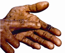 চিত্র:Arsenicosis1.jpg